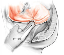 Vaginal Agenesis