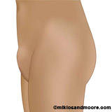 Before Mons Pubis Reduction (Vulvar Lipoplasty)