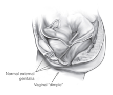 Vaginal Agenesis